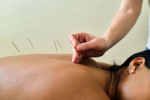 Acupuncture Treatment, Eugene, OR
