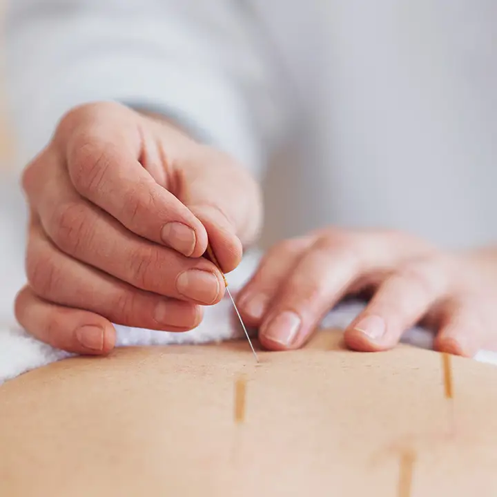 acupuncture-treatment-7120